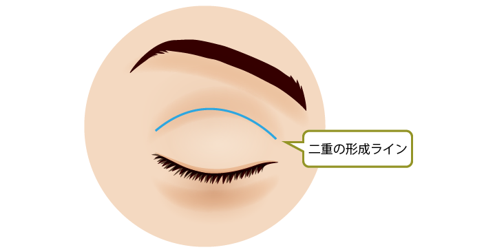 上眼瞼切開術　二重の形成ライン