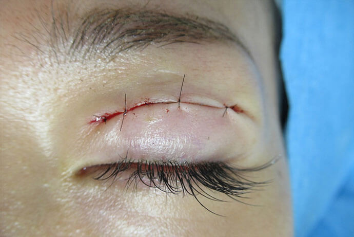上眼瞼切開術　袋とじ症例