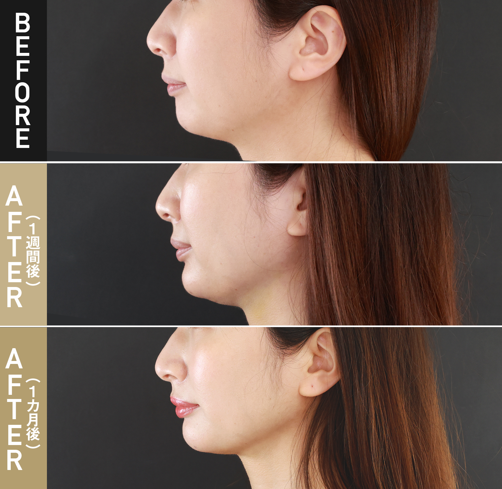 顎下脂肪吸引|症例写真（術後1週間・術後1カ月）|30代女性