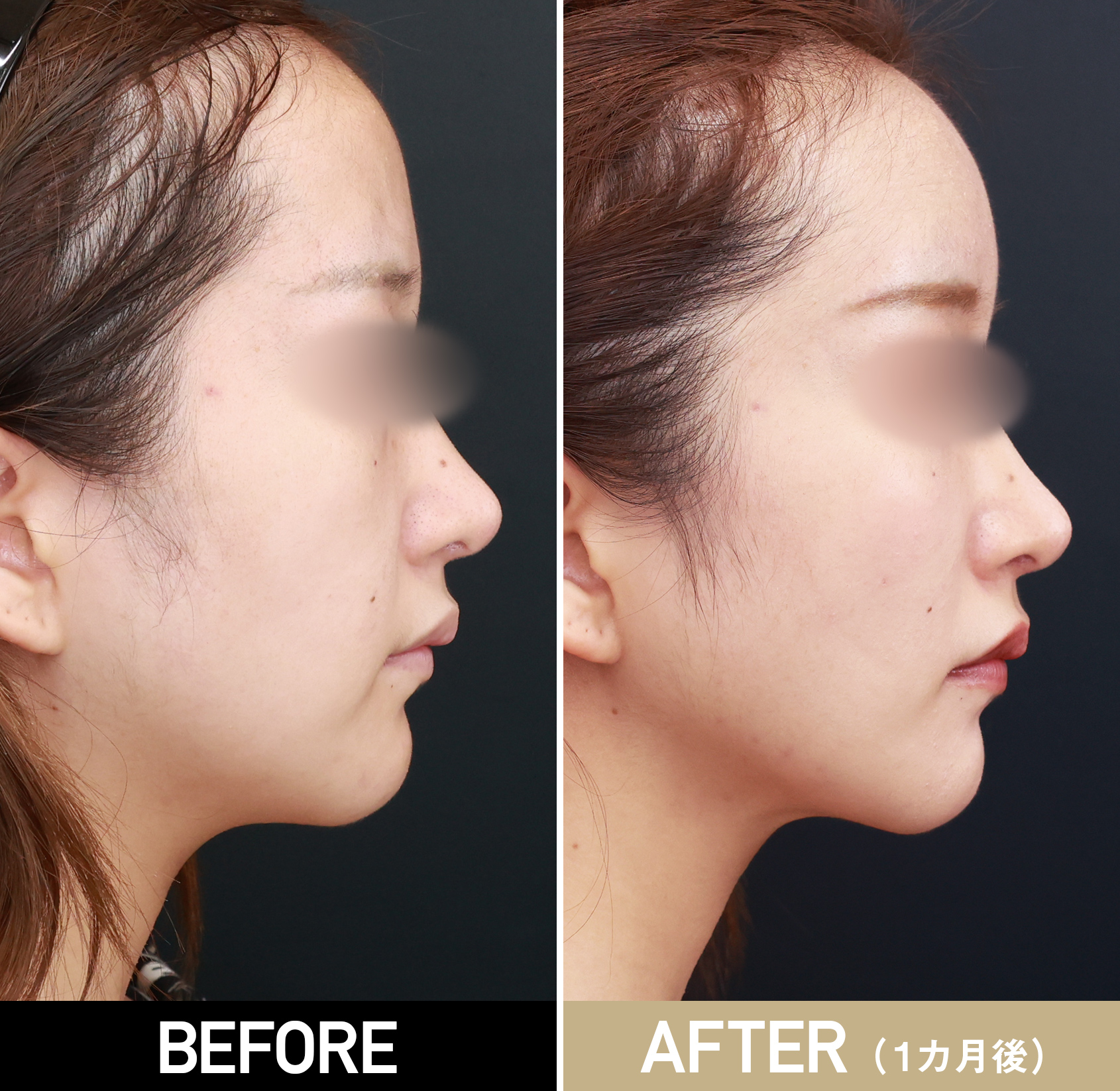 顎下脂肪吸引|症例写真（術後1カ月）|30代女性