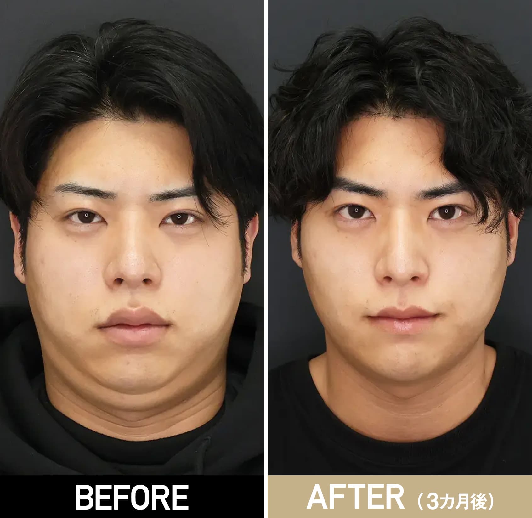 小顔整形の複合施術/20代・男性/術前・術後3ヵ月の症例画像