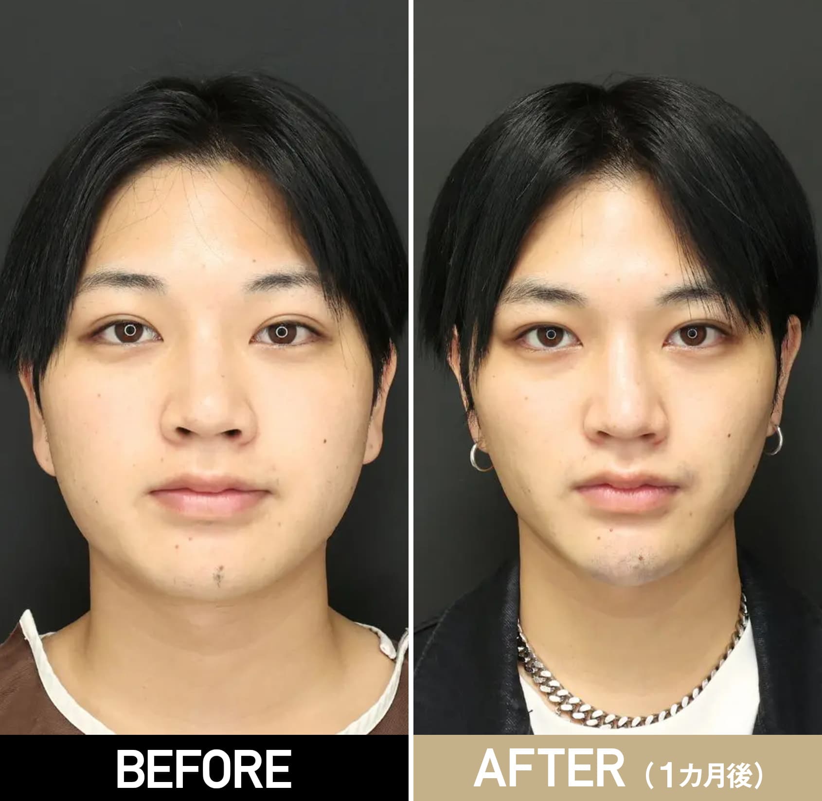 小顔整形の複合施術/20代・男性/術前・術後2ヵ月の症例画像