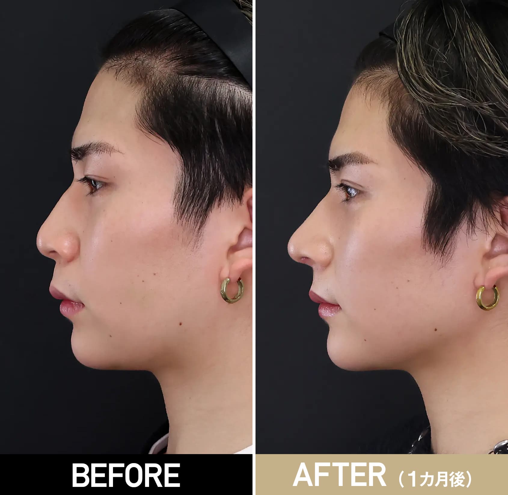 鼻整形の複合施術/20代・男性/術前・術後1ヵ月の症例画像