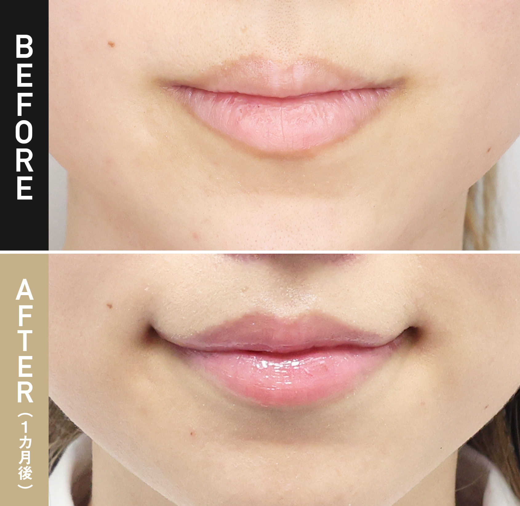 口角挙上・リフト|症例写真（術後1ヵ月）|20代女性