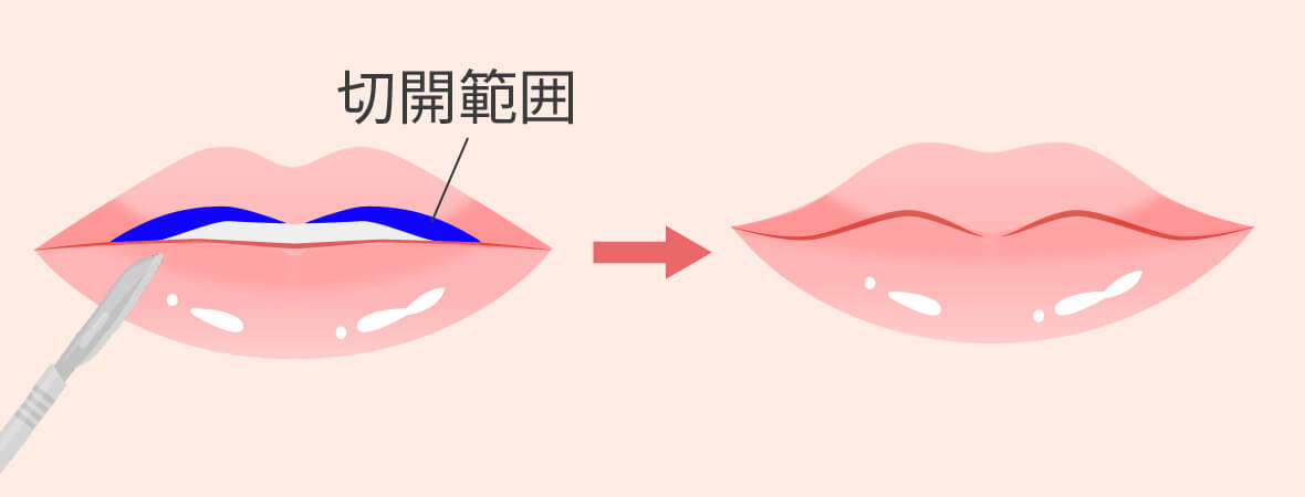 上口唇下側の粘膜の一部を二等辺三角形状に切開切除縫合しM字型のラインに形成