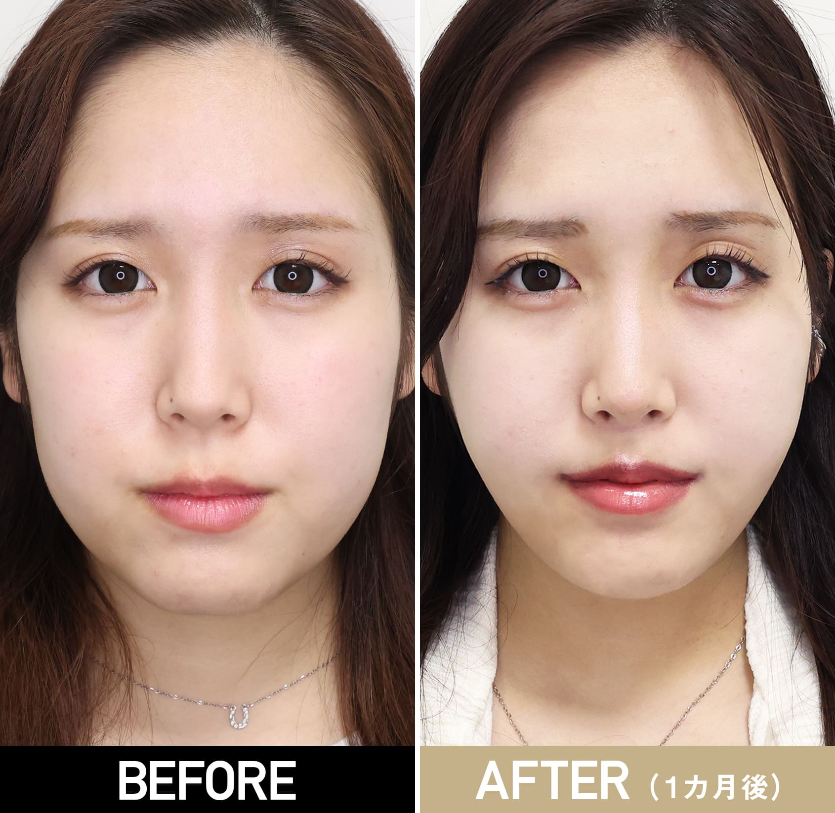 人中短縮術、口角挙上（口角リフト）|症例写真（施術前・術後1カ月）|20代女性