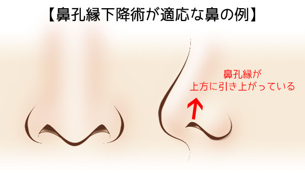 鼻孔縁下降術が適応な鼻の例