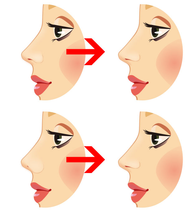 鼻孔縁挙上術は横顔の印象も変えられます