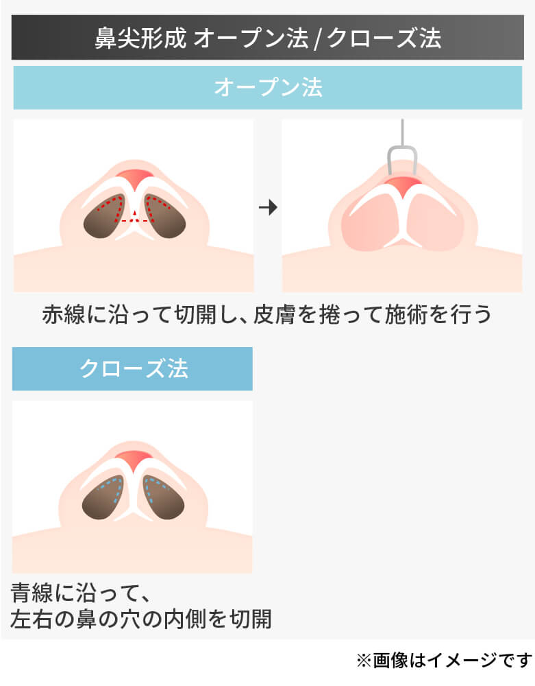 鼻尖形成のオープン法とクローズ法