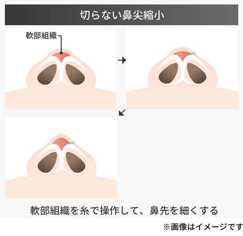 鼻尖形成のオープン法とクローズ法