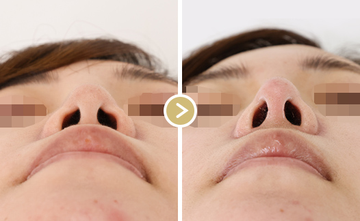 鼻尖形成の施術