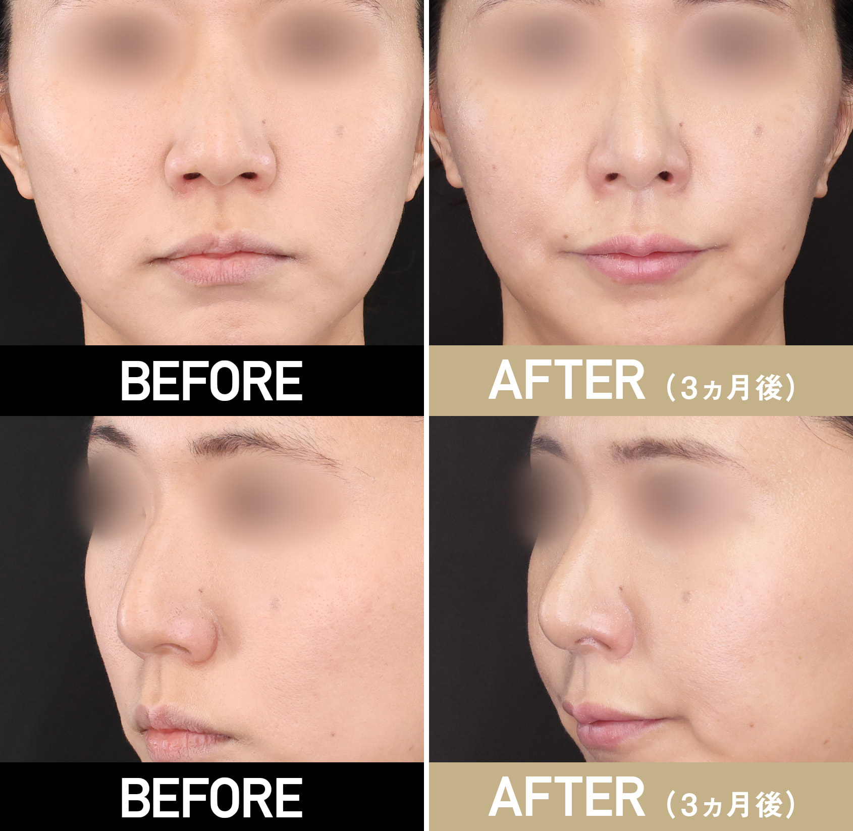 貴族手術（鼻翼基部プロテーゼ・脂肪注入）|症例写真（術後3ヵ月）|30代女性