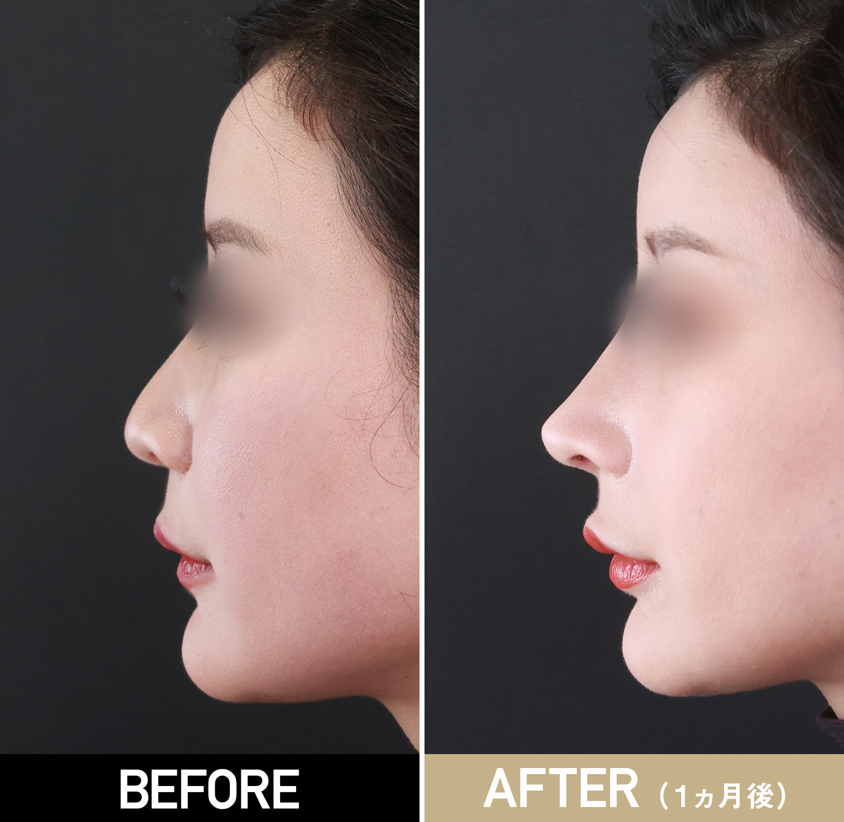 鼻整形（鼻中隔延長術、鼻先軟骨移植、隆鼻術プロテーゼ、鼻尖形成、鼻尖脱脂術など）|症例写真（施術前・術後1カ月）|20代女性
