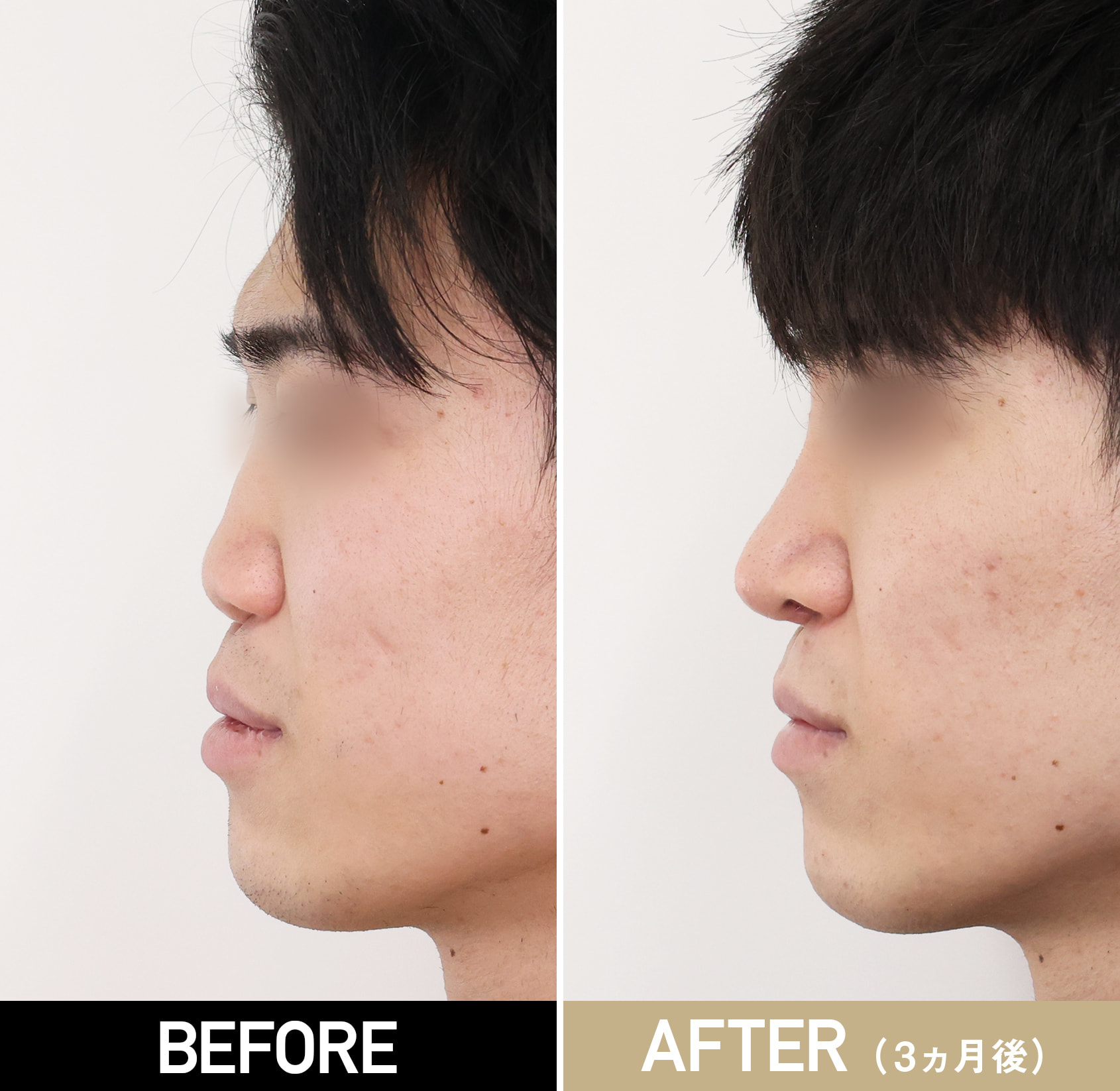 鼻整形（鼻中隔延長術、鼻尖形成、鼻先軟骨移植、隆鼻術プロテーゼ）|症例写真（施術前・術後3カ月）|20代男性