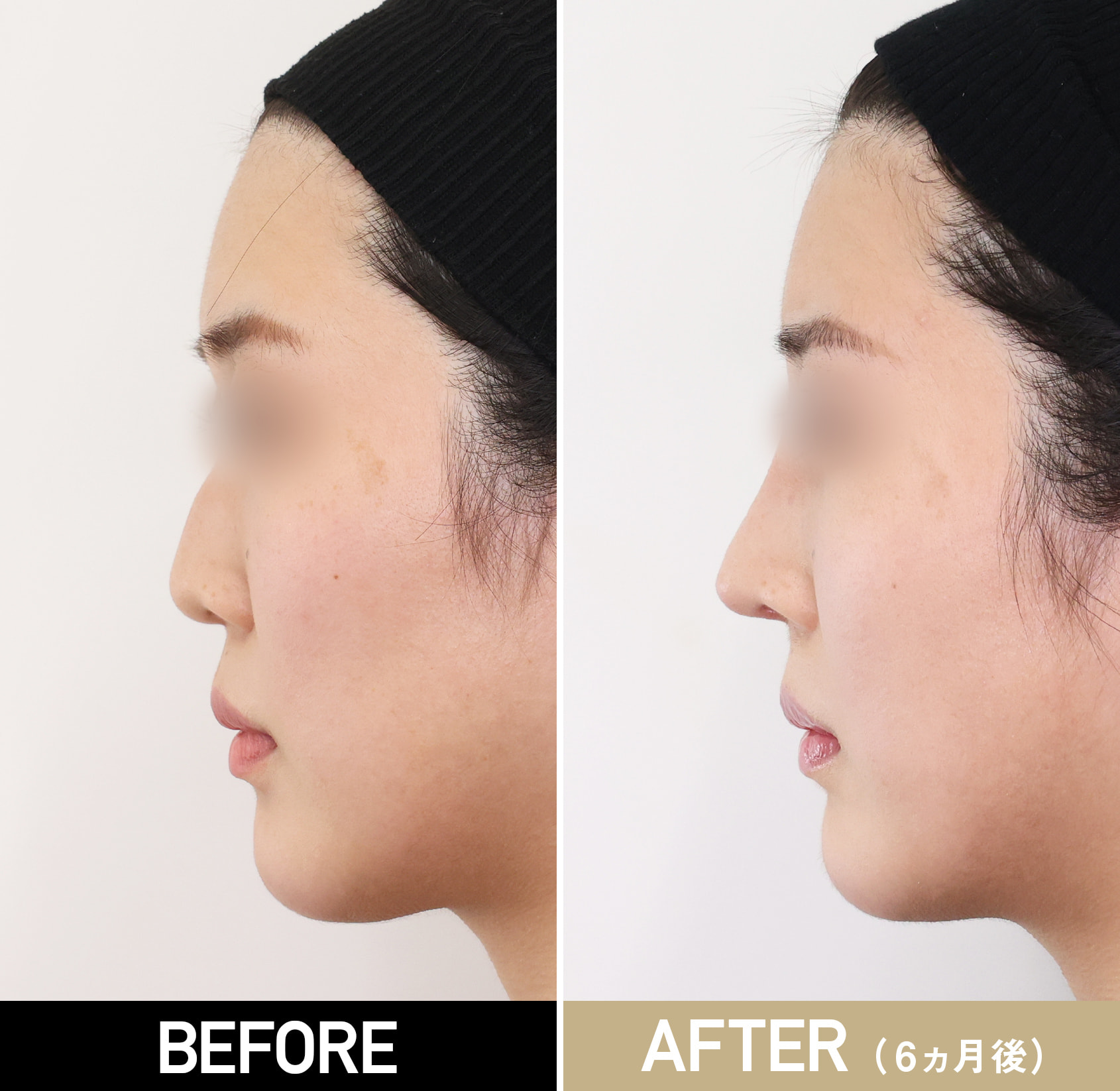 鼻整形（鼻中隔延長＋耳軟骨移植＋鼻尖形成＋Cカール形成）|20代女性
