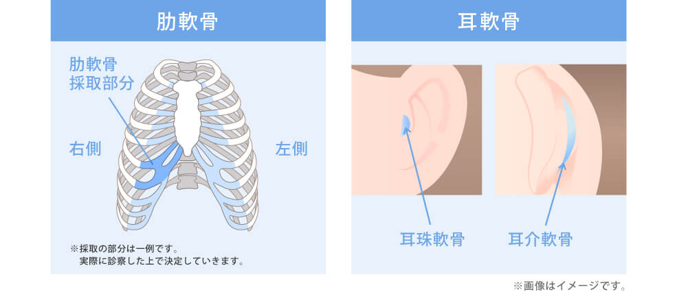 肋軟骨・耳軟骨・側頭筋膜