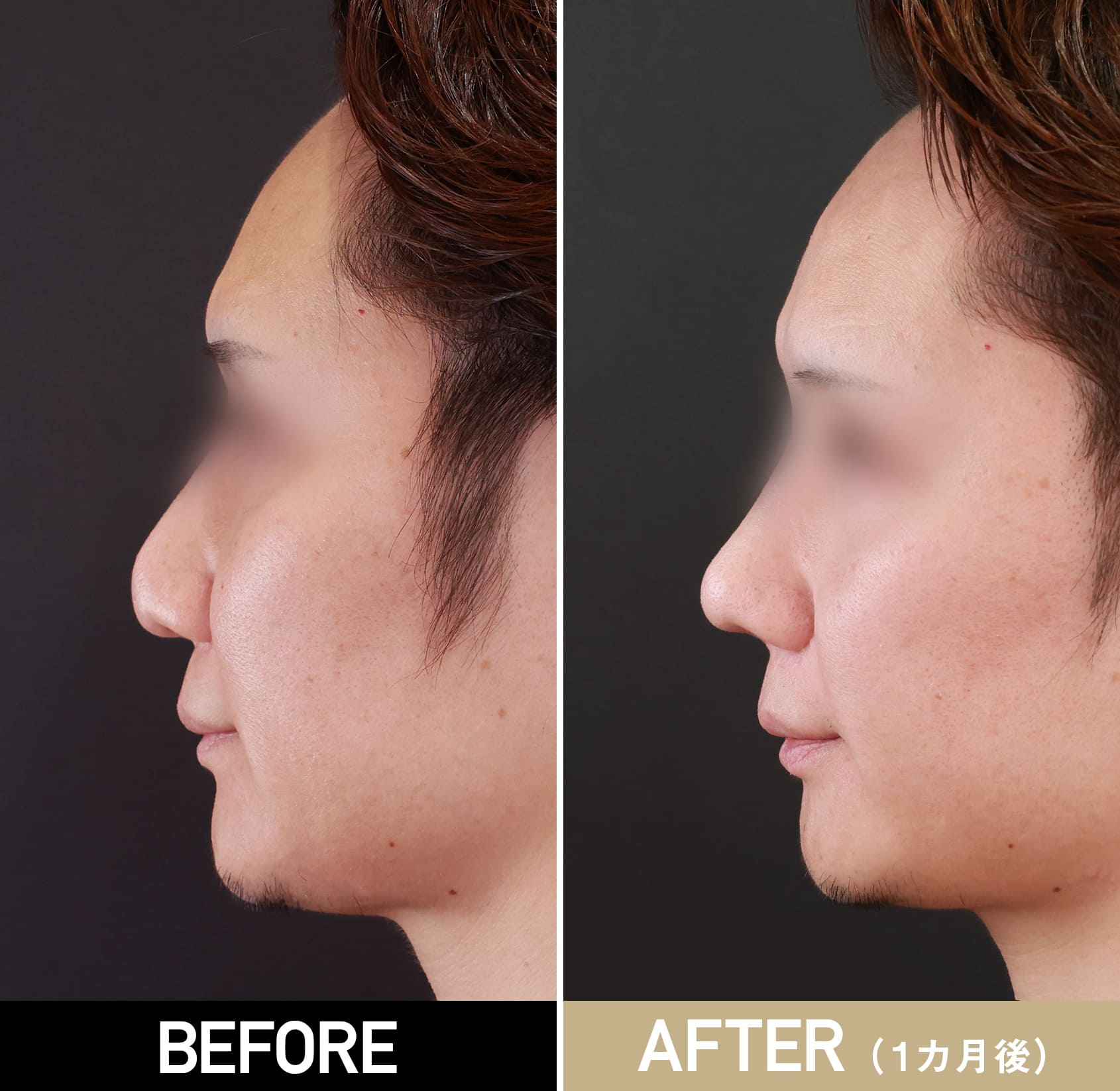 鼻プロテーゼ（隆鼻術）|症例写真（術後1ヵ月）|30代男性