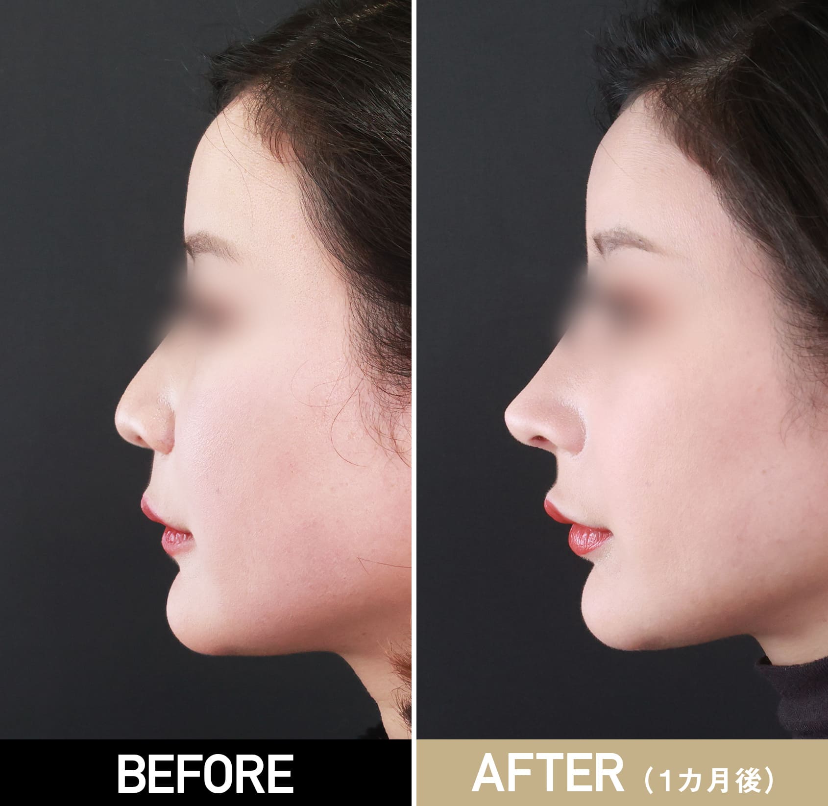 鼻プロテーゼ（隆鼻術）|症例写真（術後1ヵ月）|30代女性
