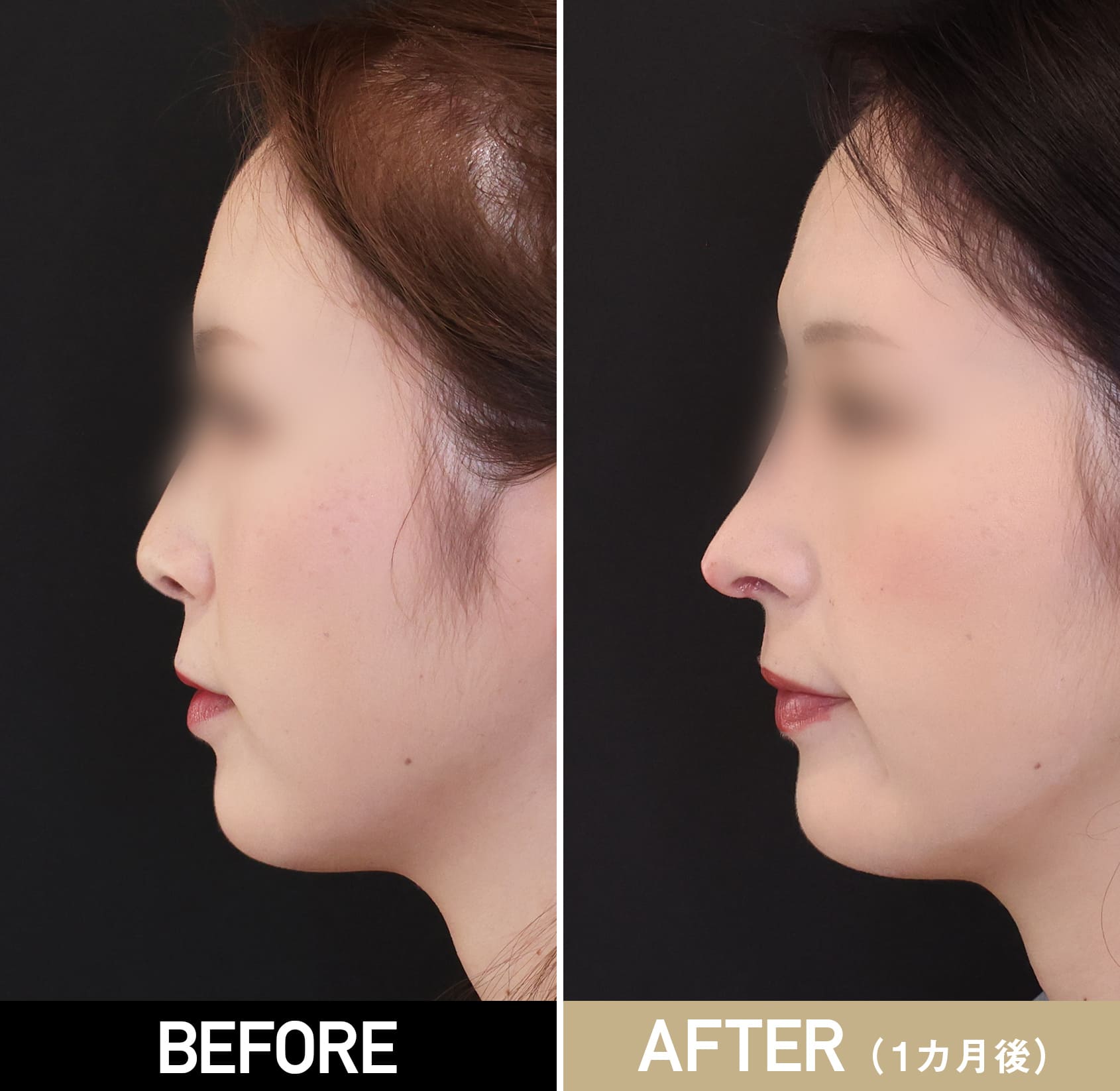 鼻プロテーゼ（隆鼻術）|症例写真（術後1ヵ月）|40代女性