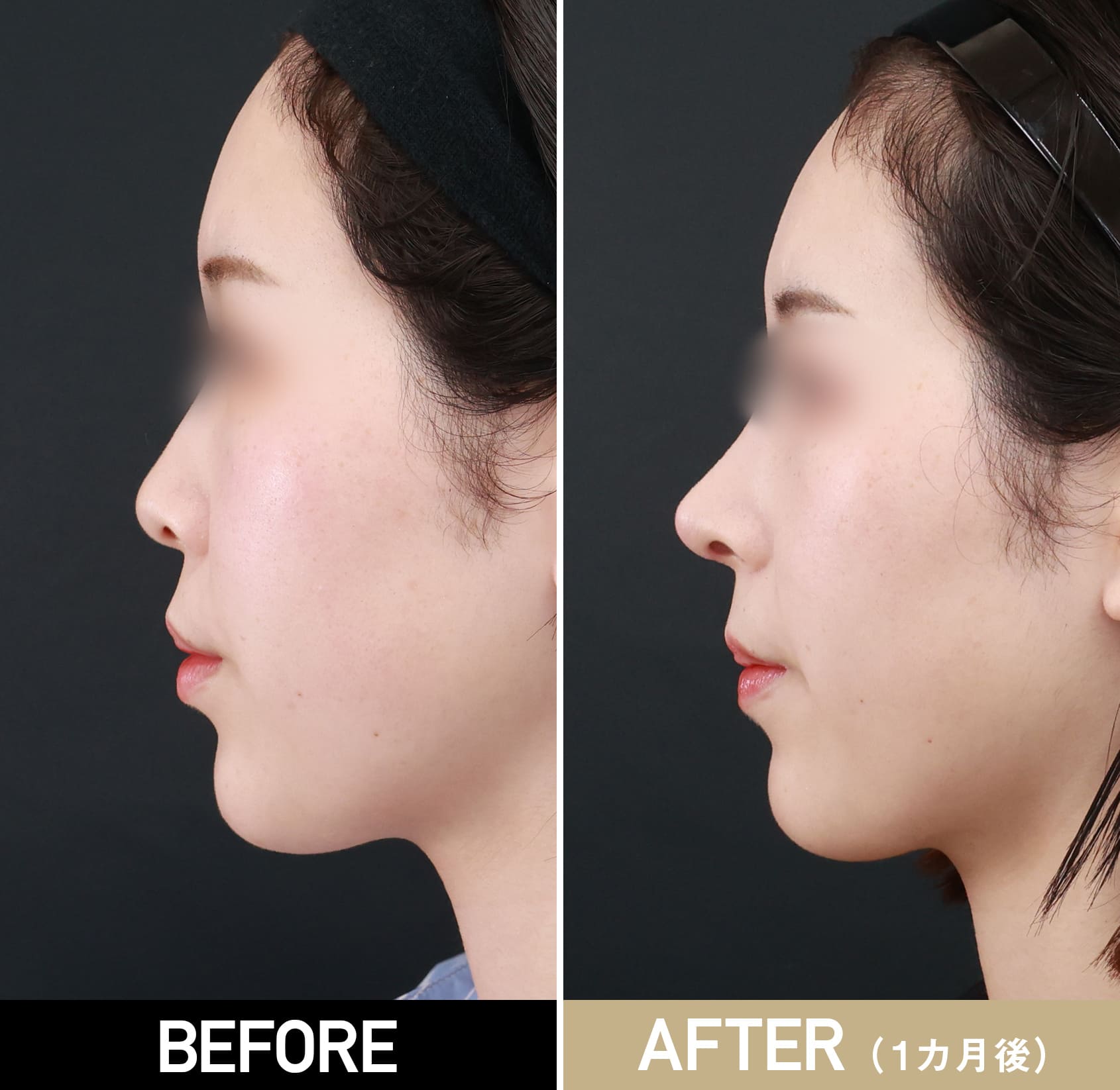 鼻プロテーゼ（隆鼻術）|症例写真（術後1ヵ月）|20代女性