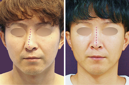 鼻整形 Taクリニック プロテーゼ 小鼻縮小 ダウンタイム 費用 症例 鼻整形のデメリット おすすめ美容外科
