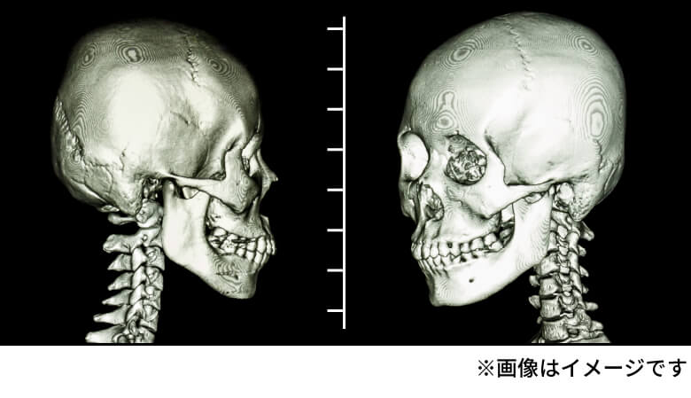 前額形成 前頭骨 眉骨削り Taクリニック 美容整形 美容外科 新宿 銀座 横浜 大阪 福岡 川越 高崎taクリニック 美容整形 美容外科 新宿 銀座 大阪 福岡 川越 高崎