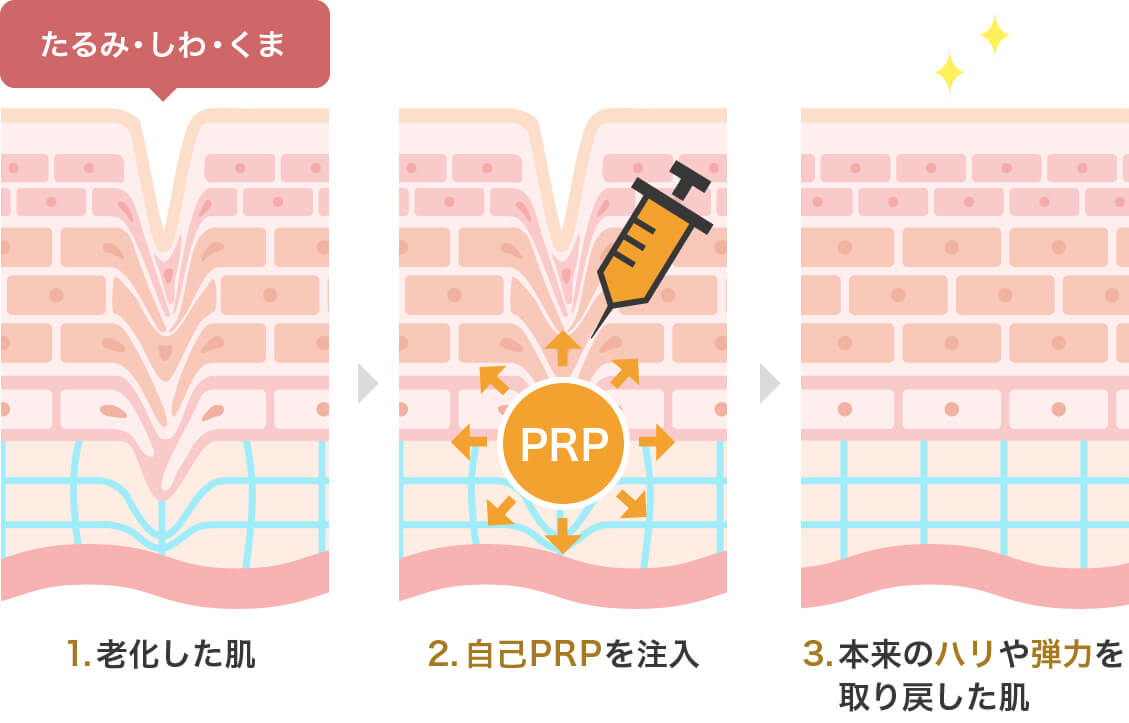 はちみつ注射（WSC-PRP）皮膚再生療法（多血小板血漿注入）の施術