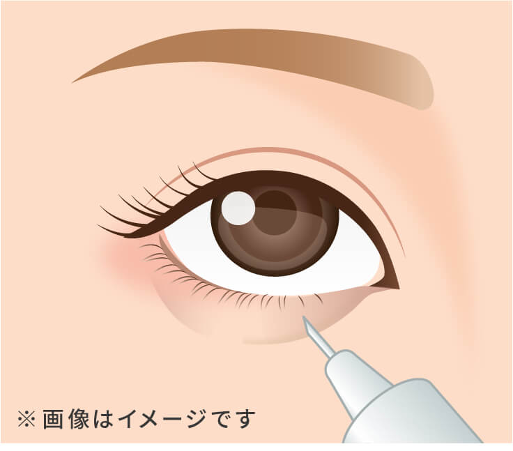目の下のヒアルロン酸注入イメージ