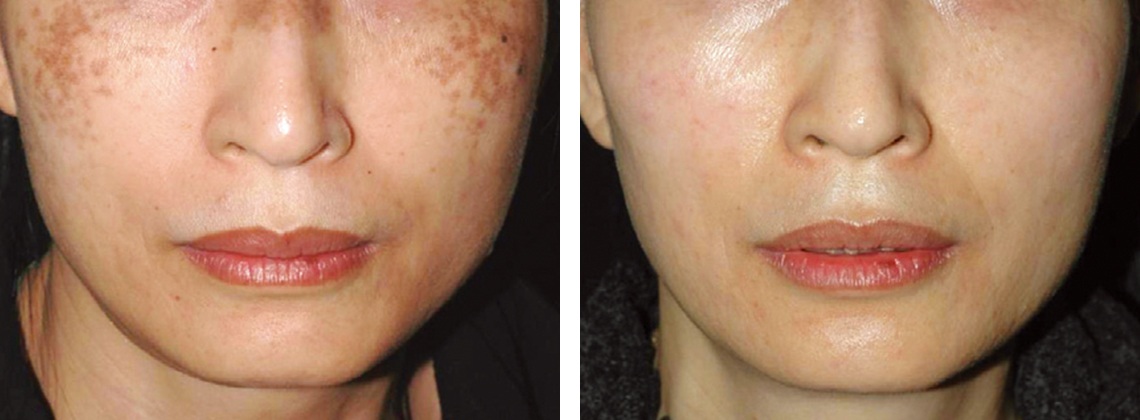 肝斑治療でレブライトSIを使用