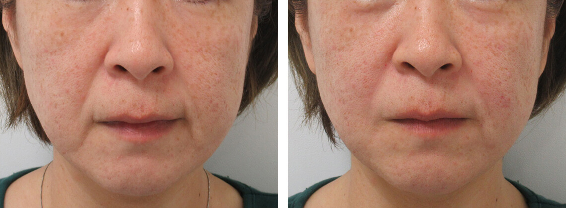 ウルトラセル（ハイフ）の症例写真 施術前後 直後