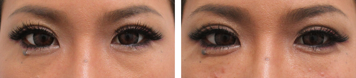 プチ整形ヒアルロン酸注射で涙袋が！