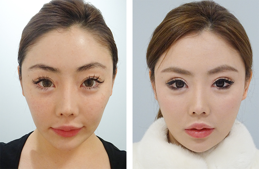 目頭切開でもっと印象的な目元に