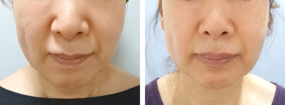 の症例写真 施術前後 3回処置