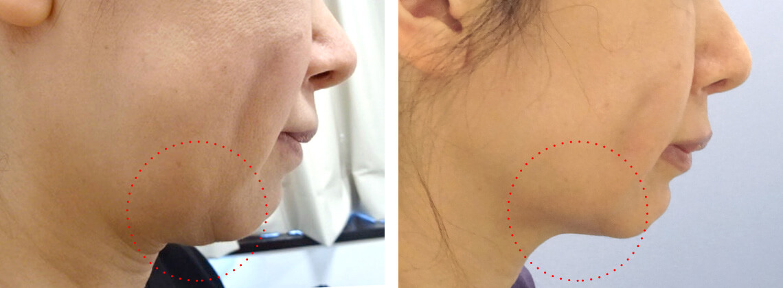 の症例写真 施術前後 3回処置