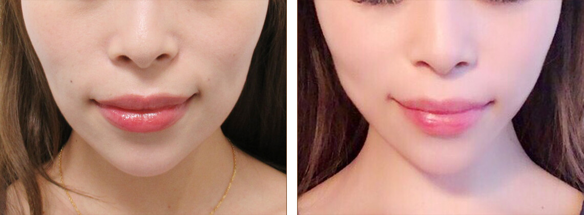 細身の方でもツヤ肌コラーゲンリフトでリフトアップ