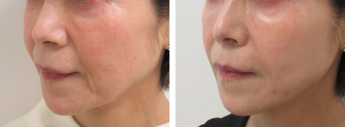 ほうれい線とマリオネットラインが…