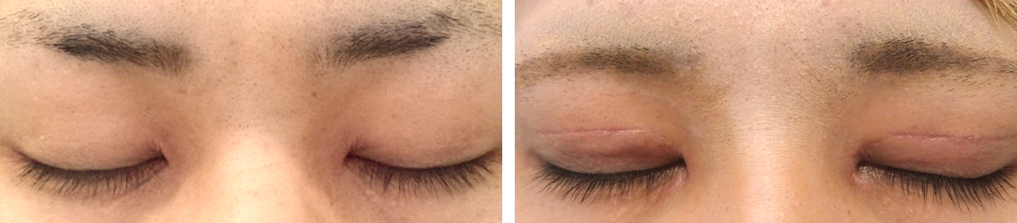 目頭切開術/二重切開（全切開法）の症例写真 施術前後 １ヶ月