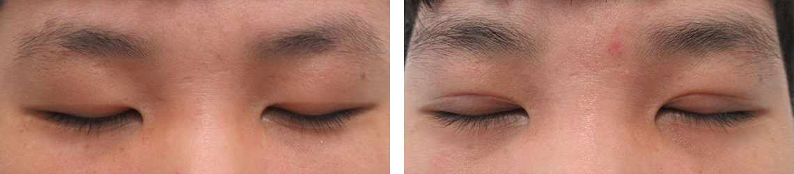 二重埋没法/眼瞼下垂（目つき矯正）の症例写真 施術前後 １ヶ月