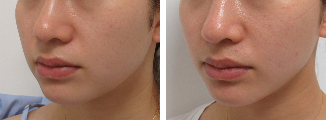 TAC式 ツヤ肌コラーゲンリフト®の症例写真 施術前後 １ヶ月