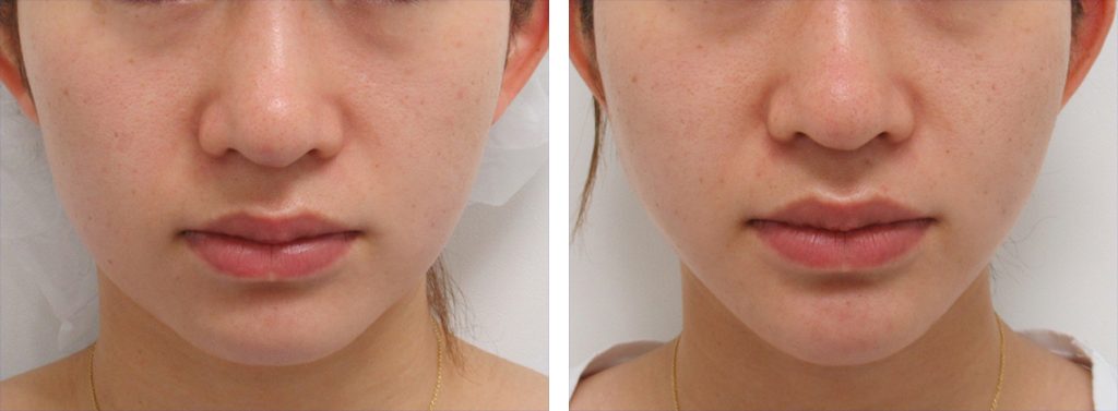 症例写真 ダウンタイム ツヤ肌と脂肪溶解注射で輪郭形成 Taクリニックグループ 美容整形 美容外科 全国展開中