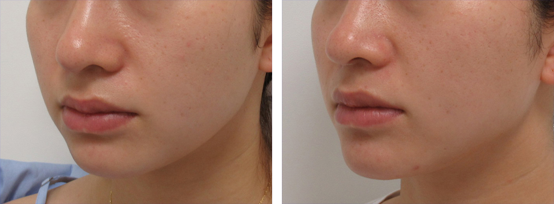 TAC式 ツヤ肌コラーゲンリフト®の症例写真 施術前後 ３週間
