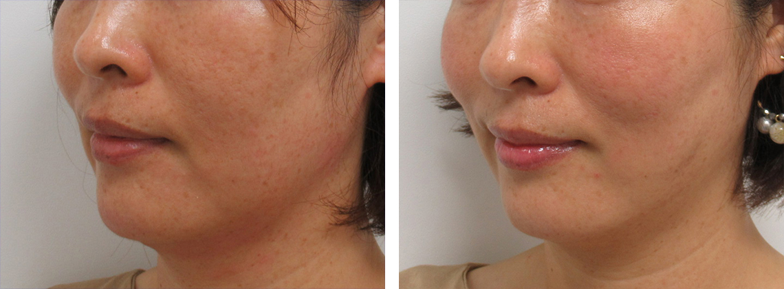 TAC式 ツヤ肌コラーゲンリフト®の症例写真 施術前後 1ヶ月