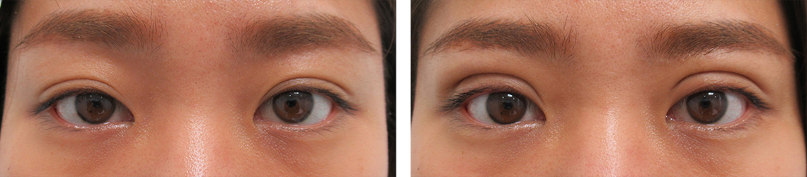 二重埋没法/眼瞼下垂（目つき矯正）の症例写真 施術前後 直後