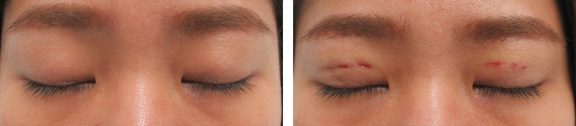 二重埋没法/眼瞼下垂（目つき矯正）の症例写真 施術前後 直後