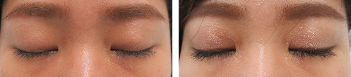 二重埋没法/眼瞼下垂（目つき矯正）の症例写真 施術前後 １ヶ月