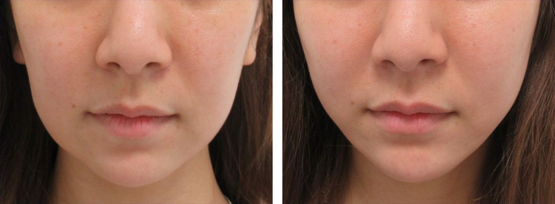 下垂してたるんだフェイスライン