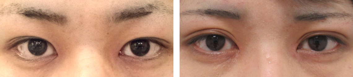 目頭切開術/二重切開（全切開法）の症例写真 施術前後 ３ヶ月