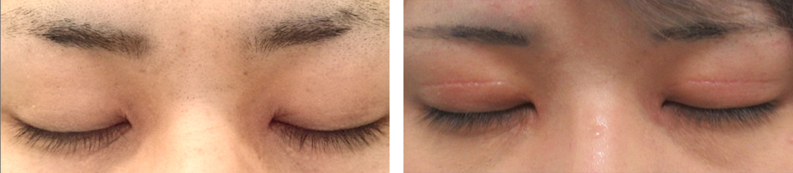 目頭切開術/二重切開（全切開法）の症例写真 施術前後 ３ヶ月