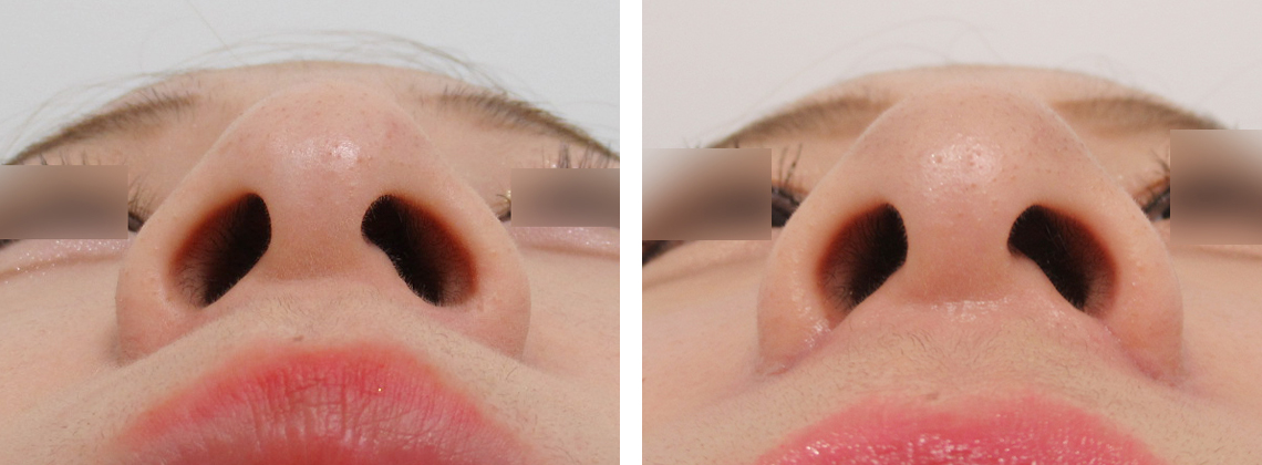 TAC式 鼻翼縮小術（小鼻縮小）の症例写真 施術前後 1ヶ月