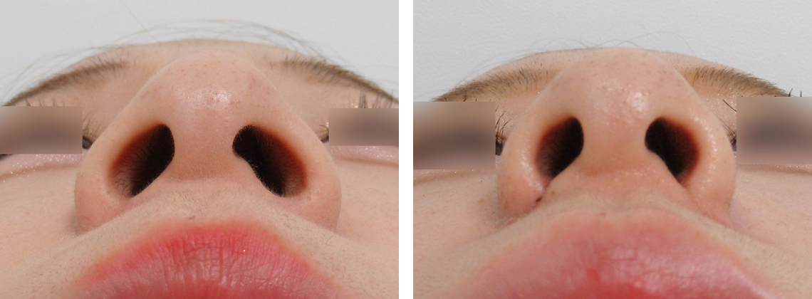TAC式 鼻翼縮小術（小鼻縮小）の症例写真 施術前後 1週間